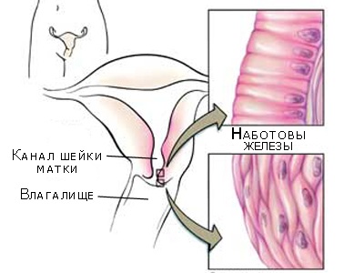 Наботовы кисты шейки матки у женщин