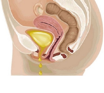 Недержание мочи при климаксе