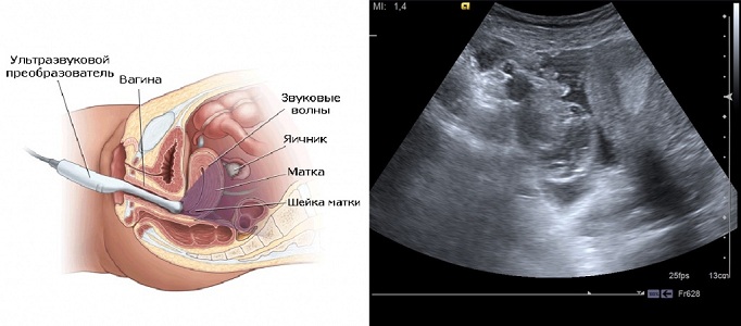 Недостатки УЗИ при месячных