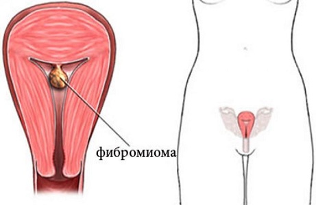 Образование фибромиомы матки