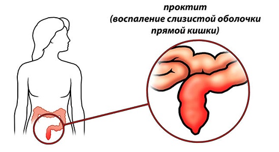 Образование свища на фоне воспалительных процессов