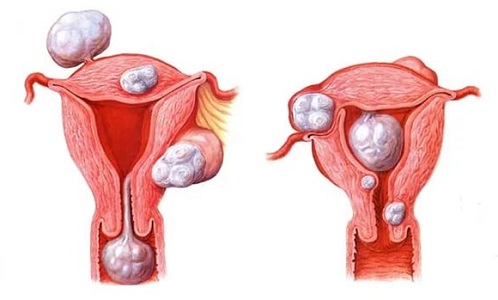 Оперативное лечение миомы матки