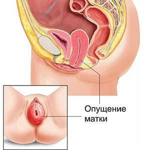 Опущение матки