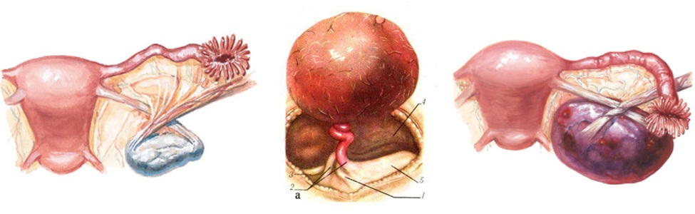Осложнения кисты яичника