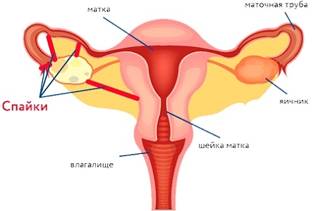 Осложнения после маточного кровотечения