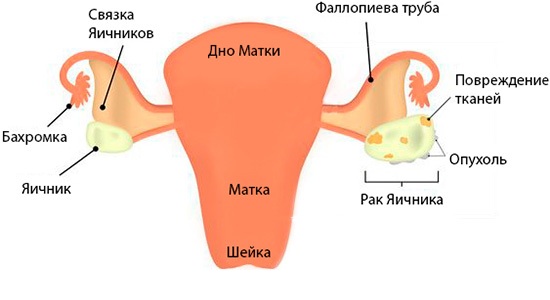 Осложнения при многокамерной кисте яичника