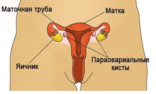 Параовариальные кисты