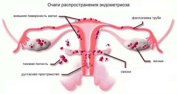 Патологические боли живота при месячных