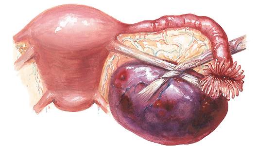 Перекрут параовариальной кисты
