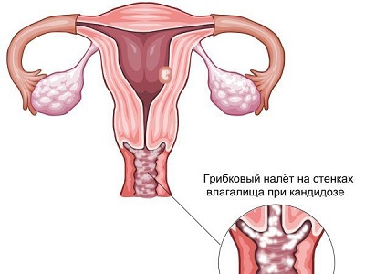 Показания к применению Нистатина при молочнице