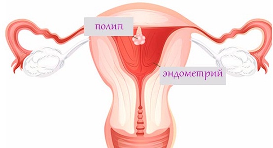 Полип эндометрия или тела матки