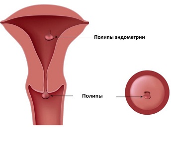 Полип эндометрия