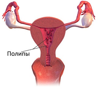 Полипы в матке