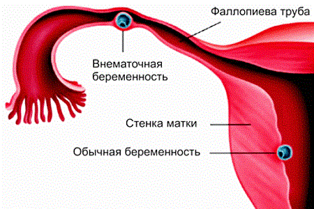 Последствия аднексита