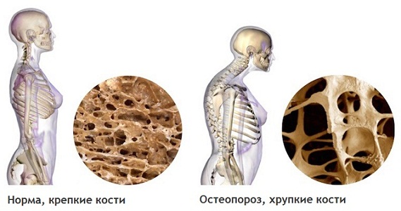 Постменопауза и остеопороз