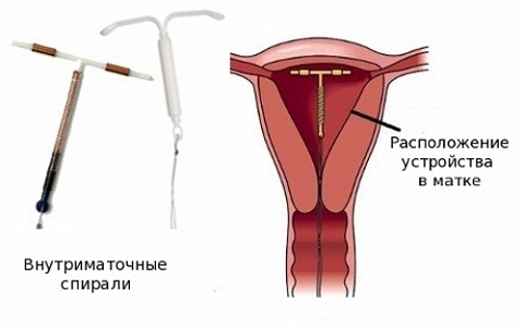 Преимущества контрацептива Мирена