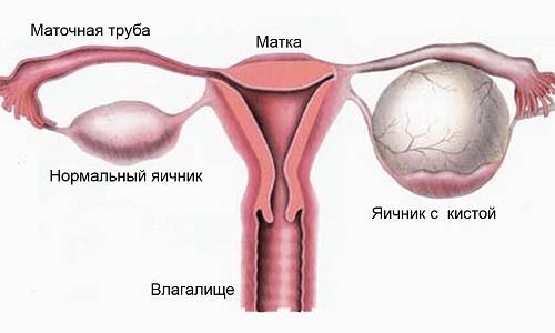 Препарат Дюфастон при кисте яичника