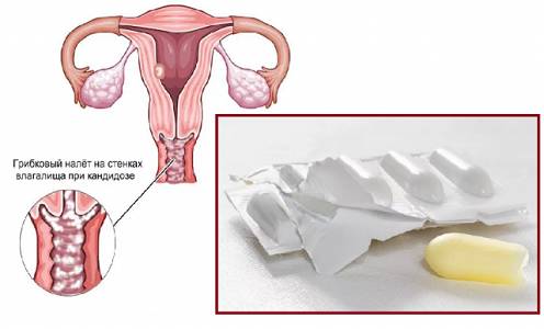 Препарат Нео-пенотран при молочнице