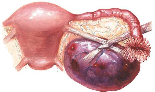 Причины апоплексии яичников