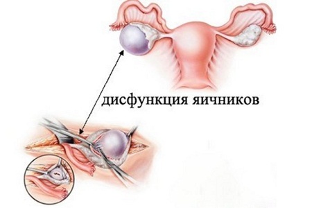 Причины кровотечений матки