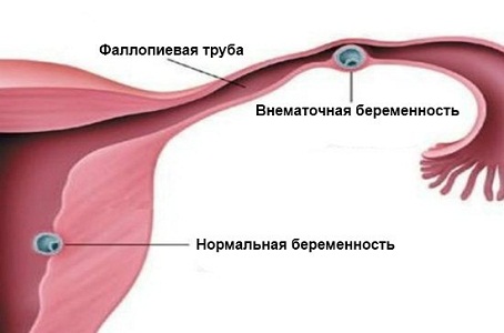 Причины метроррагии