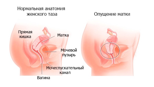 Причины опущения матки