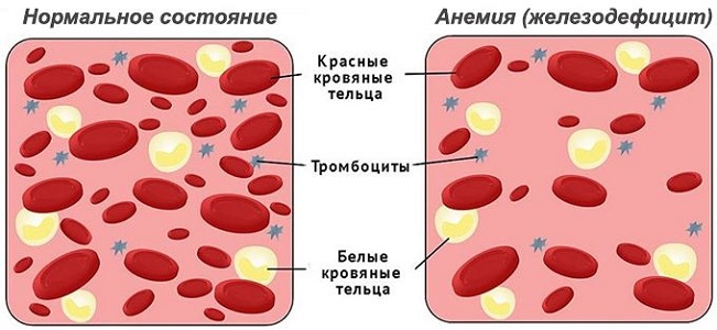 Причины повышения тромбоцитов во время месячных