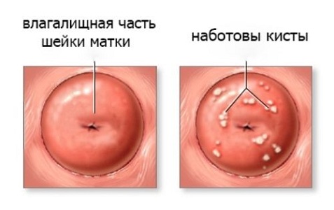 Причины появления наботовых кист шейки матки