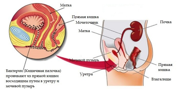 Причины цистита во время климакса