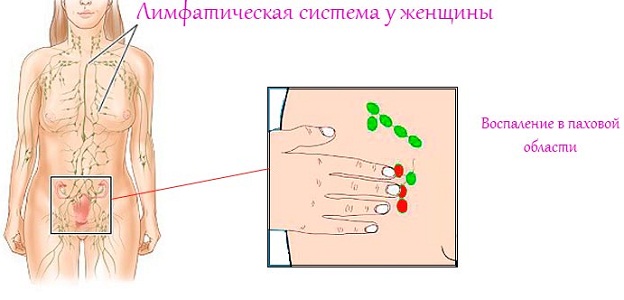 Причины воспаления паховых лимфоузлов перед месячными