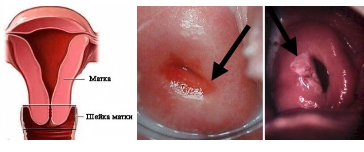 Признаки лейкоплакии шейки матки