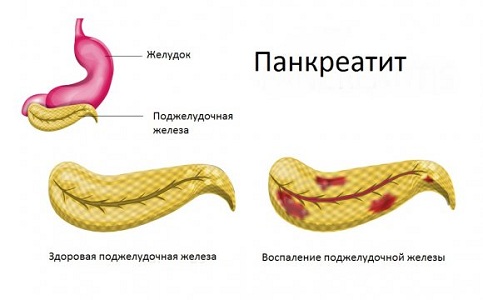 Противопоказания контрацептива Клайра