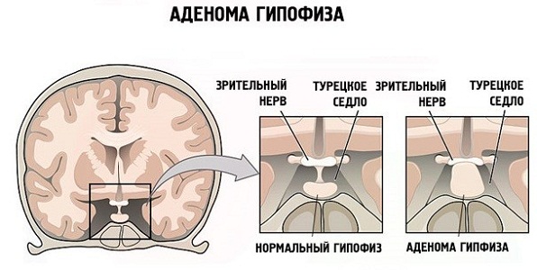 Противопоказания стимуляции овуляции Клостилбегитом