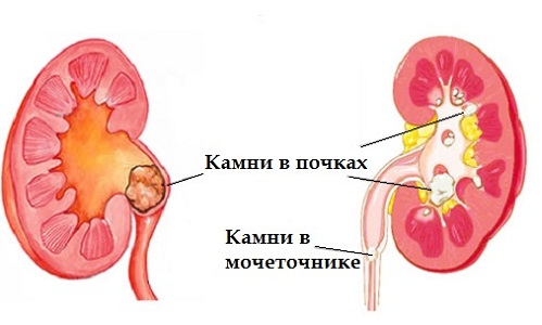 Противопоказания витамина С