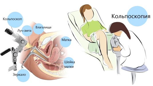 Процедура кольпоскопия