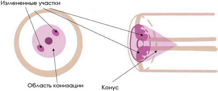 Процедура конизация шейки матки