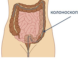 Проведение колоноскопии при месячных и беременности