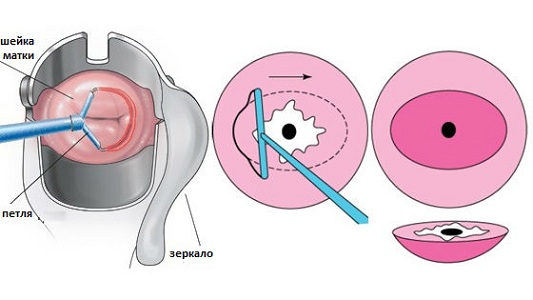 Радиоволновая конизация шейки матки