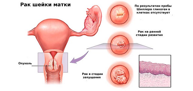 Рак шейки матки