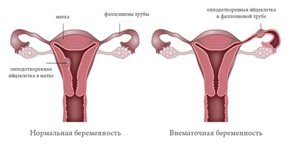 Розовые выделения при внематочной беременности