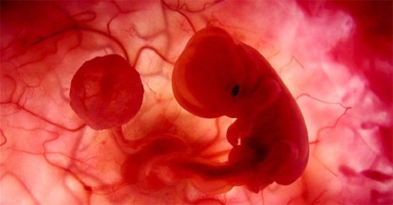 Самопроизвольный аборт при двурогости матки