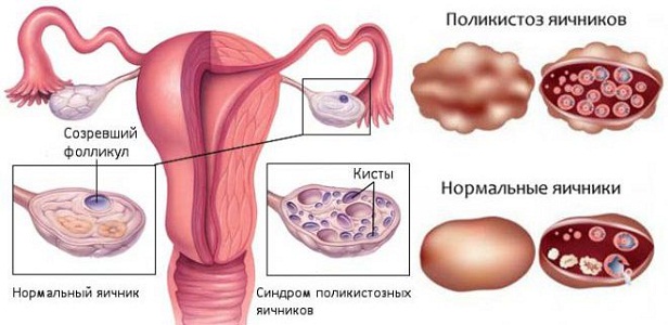 Сбой менструального цикла при поликистозе яичников