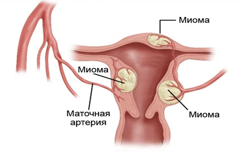 Сгустки крови при патологиях