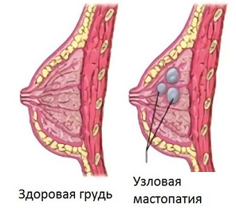 Причины боли груди перед месячными