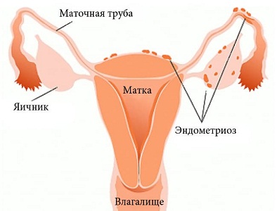 Слизистые месячные при эндометриозе