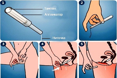 Способ использования тампона с аппликатором