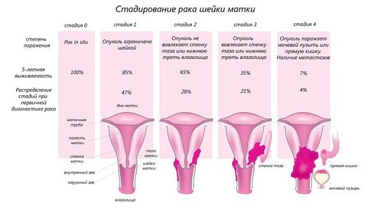 Стадии рака шейки матки