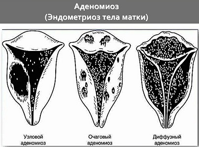 Степени аденомиоза матки