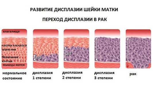 Степени дисплазии шейки матки