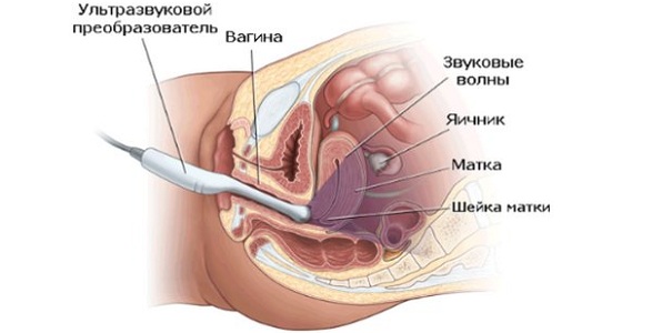 Трансвагинальное обследование при миоме матки
